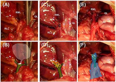 Case Report: Surgical Correction of a Cystic Duct Stump Leakage Following Cholecystectomy Using an Autologous Rectus Sheath Graft in a Dog